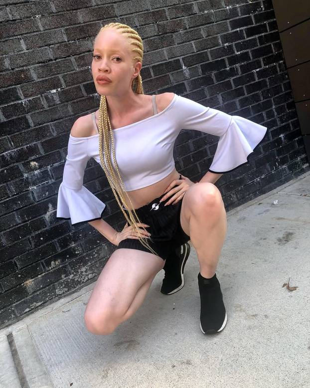 FOTO Afrikanka s albinizmom osvaja modnu industriju: 'Često privlačim znatiželjne poglede'