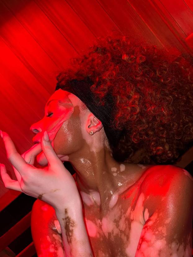 FOTO Rugali su joj se zbog bolesti, a danas je obožavaju zbog jedinstvenog izgleda