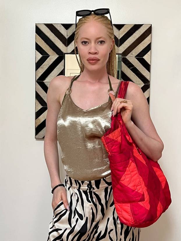 FOTO Afrikanka s albinizmom osvaja modnu industriju: 'Često privlačim znatiželjne poglede'