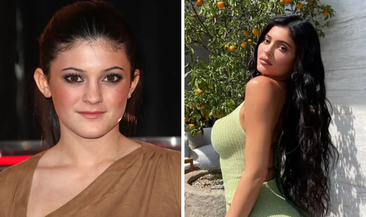Sve operacije Kylie Jenner: Od iznosa &cacute;e vas zaboljeti glava