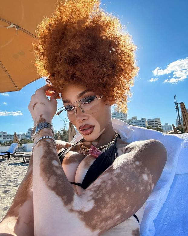 FOTO Rugali su joj se zbog bolesti, a danas je obožavaju zbog jedinstvenog izgleda