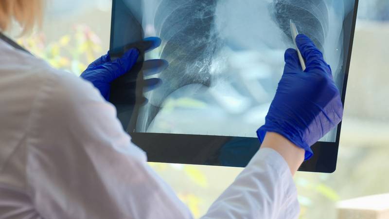 Liječnik tvrdi: 'U Hrvatskoj je niska incidencija tuberkuloze. Migracije su je malo povećale'