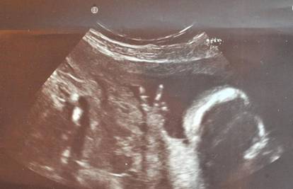 Beba pokazala mami preko ultrazvuka znak 'V' rukom