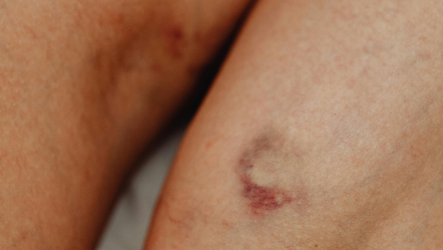 Imate proširene vene? Ovo su stvari na koje morate pripaziti