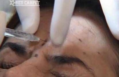Gianna Apostolski istrpjela injekcije botoksa u čelo
