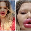 FOTO Žena s najvećim usnama na svijetu otkrila kako je nekoć izgledala: Šok! Bila si prekrasna
