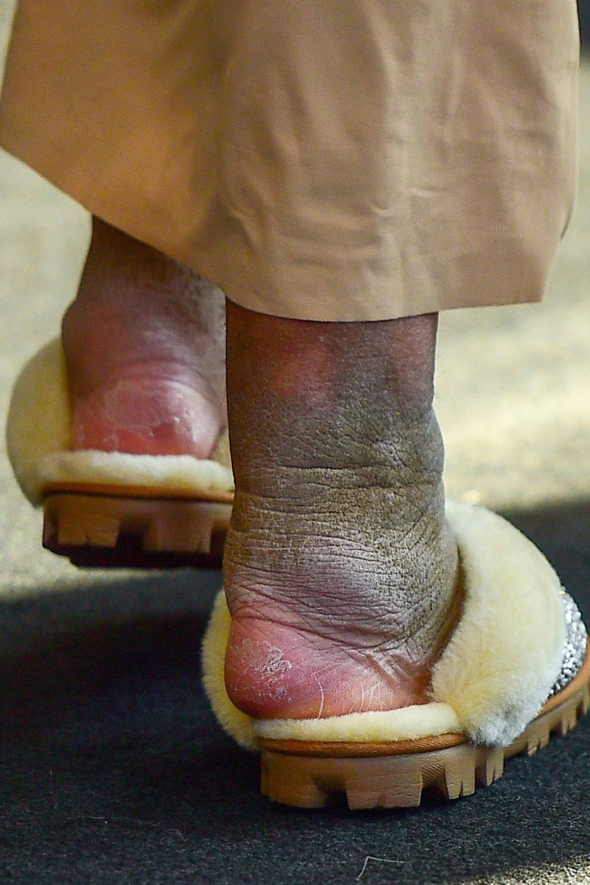 *PREMIUM-EXCLUSIVE* Wendy Williams arriving at her office displaying what Lymphedema is causing to her ankles!