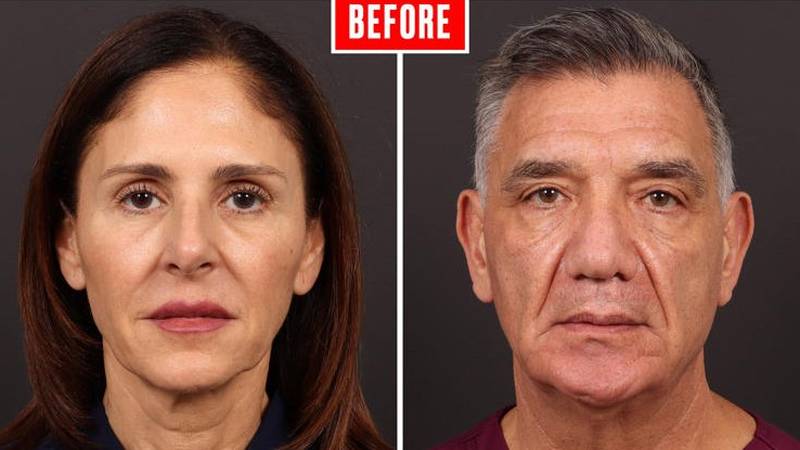 Nakon što je vidio rezultate zatezanja lica na svojoj ženi i sam se odlučio na isti zahvat