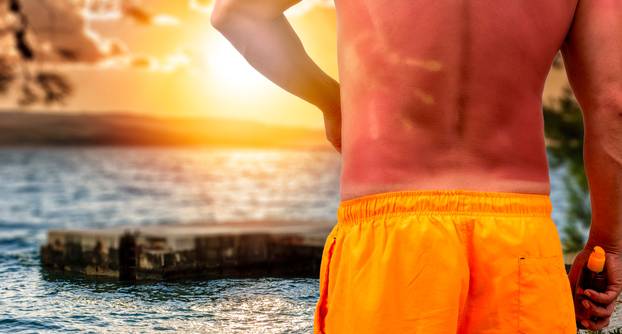 Man with sunburned skin