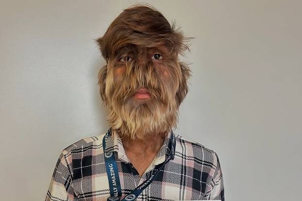 FOTO Ovaj mladić (18) pati od sindroma vukodlaka: U školi me sprdaju, ali volim svoje dlake...