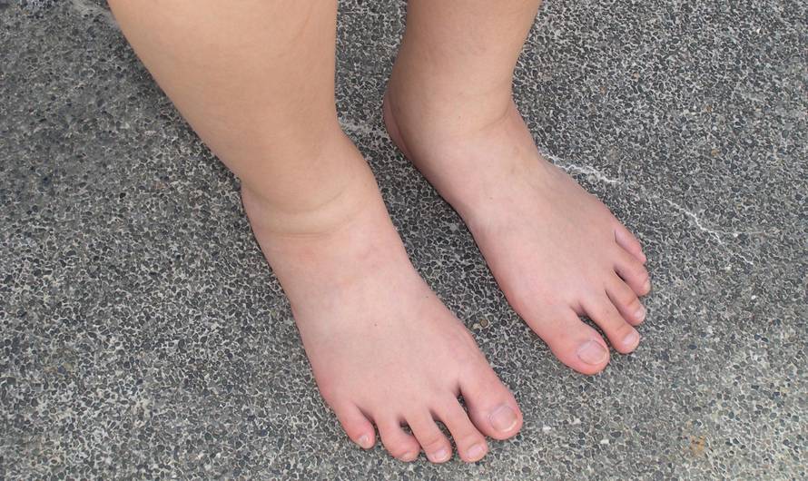 8 najčešćih razloga oticanja nogu - spriječite, a ne liječite!