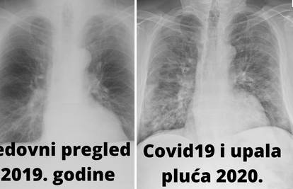 Covid je Hrvatu uništio zdrava pluća: 'Prošle godine su bila čista. Posljedice će biti trajne'