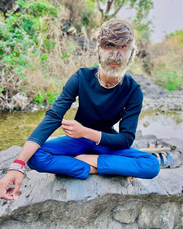 FOTO Ovaj mladić (18) pati od sindroma vukodlaka: U školi me sprdaju, ali volim svoje dlake...