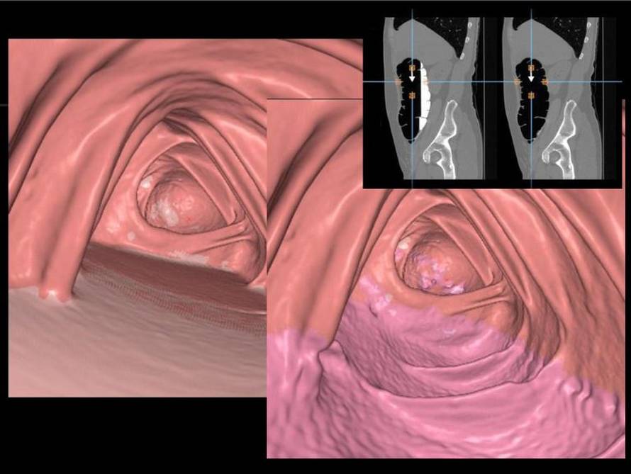 Rak debelog crijeva sve češći kod mlađih od 50: uloga CT kolonografije u dijagnostici