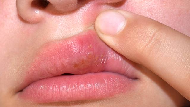 Opasna zaraza: Miješa se DNK oralnog i genitalnog herpesa