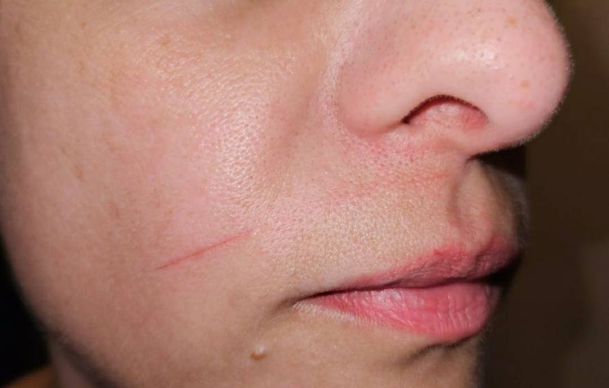 VIDEO Strava na Čiovu: 'Netko je razvukao ribolovnu nit preko ceste. Zarezala me po licu!'