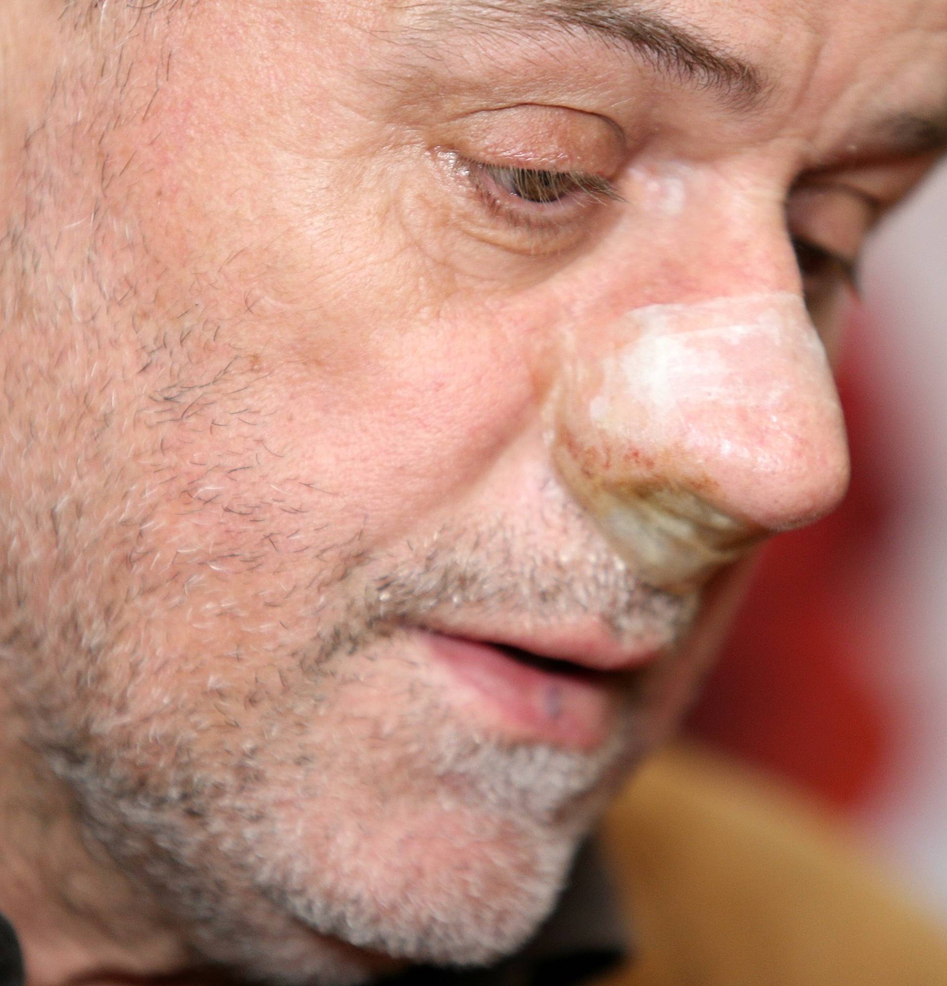 Komplikacije zbog nosa: Milan Bandić hospitaliziran na Rebru