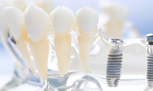 Nove mogućnosti nadoknade gubitka zuba uz implantologiju