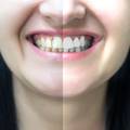 Žuti zubi su snažniji od bijelih zato ne forsirajte izbjeljivanje