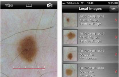 Pametni telefon okriva imate li melanom, skenira vašu kožu