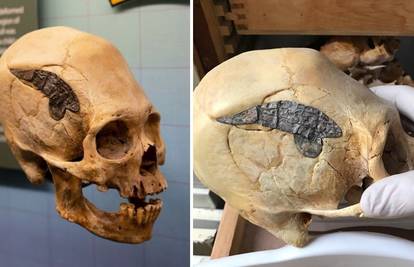 Prije 2000 godina ratniku koji je ozlijeđen u borbi ugradili su metalni implantat u lubanju