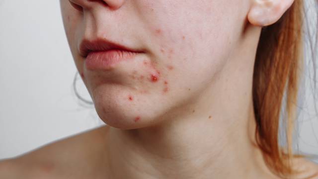 Uporne akne: Gdje sve na licu izbijaju i kako ih treba liječiti