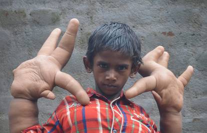Dječak ima divovske ruke: Ne ide u školu jer ga se djeca boje 