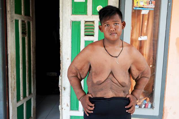 World?s Heaviest Kid Loses 220lbs