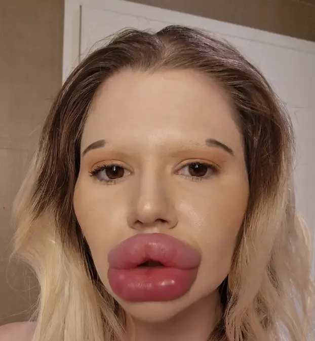 FOTO Žena s najvećim usnama na svijetu otkrila kako je nekoć izgledala: Šok! Bila si prekrasna