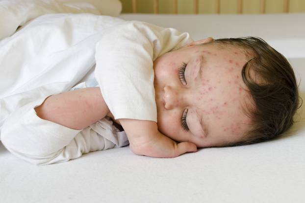 Child with chicken pox