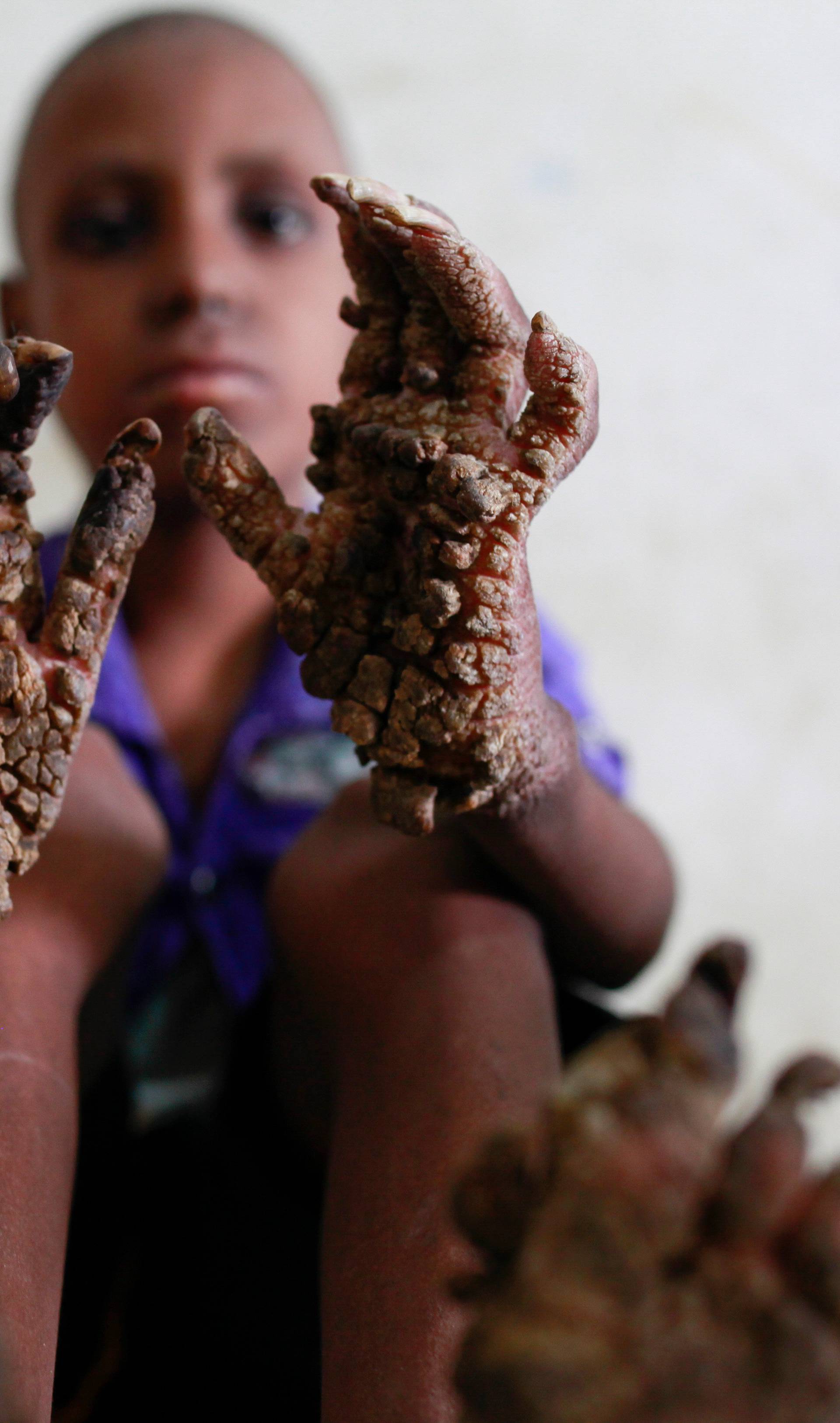 Bangladeshi 'Tree Boy'