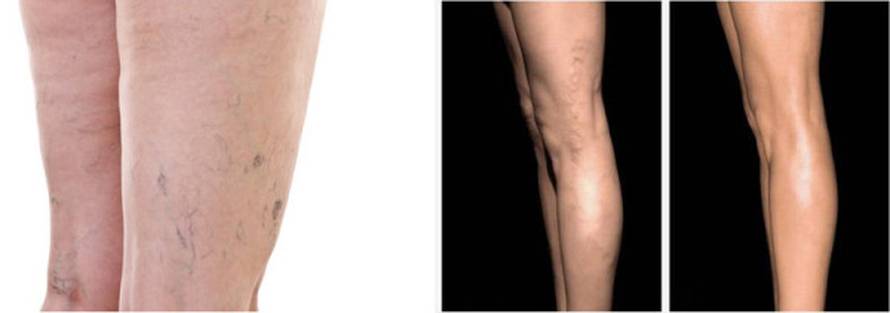 Svaka 2. hrvatica pati od proširenih vena! Poduzmite nešto