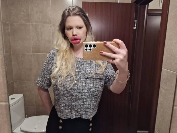 FOTO Andrea ima najveće usne na svijetu: Teško se smijem, ali ne mislim stati s operacijama...