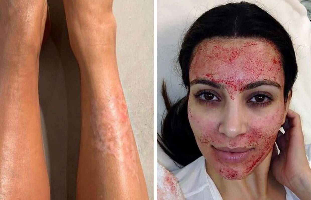 Borba sa psorijazom: Kim zbog rana prekriva tijelo puderom...