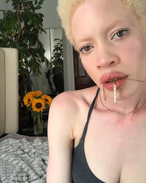 FOTO Afrikanka s albinizmom osvaja modnu industriju: 'Često privlačim znatiželjne poglede'