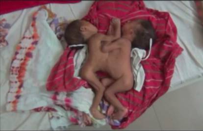 Rodila je sijamske blizance: Dečkići imaju zajedničku jetru