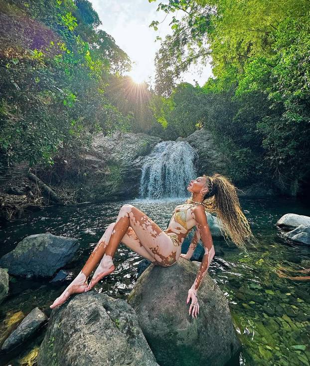 FOTO Rugali su joj se zbog bolesti, a danas je obožavaju zbog jedinstvenog izgleda