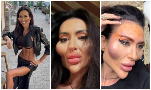Žena s 'najvećim obrazima na svijetu' objavila fotografiju iz mladosti: 'Šok! Šteta ljepote'