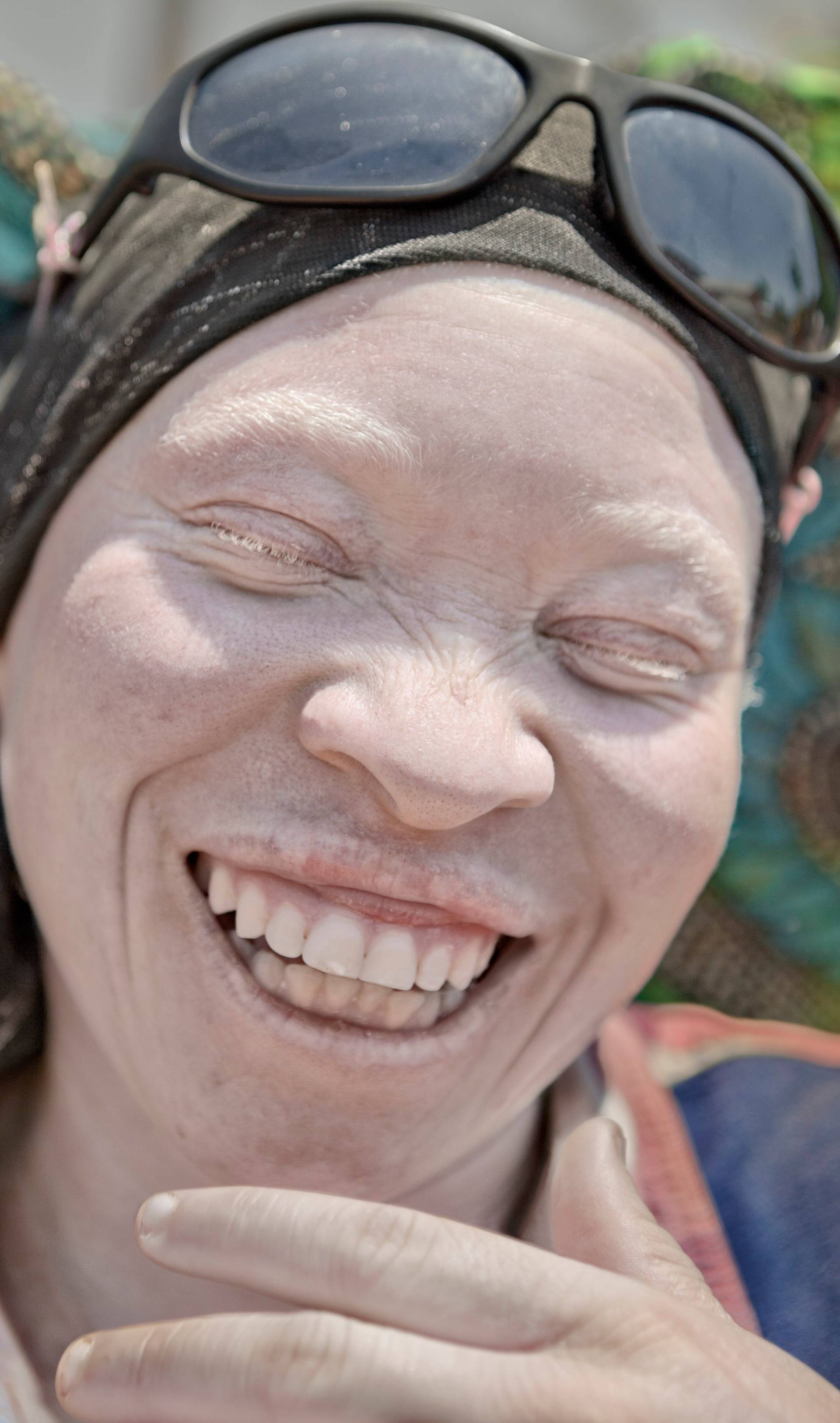 Persecuted: Albino People Seek Refuge From Vicious Body Part Traffickers