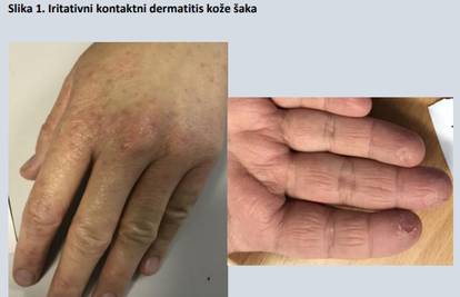 Dezinficijensi i rukavice iritiraju kožu: Evo kako možete umanjiti oštećenja na svojim rukama