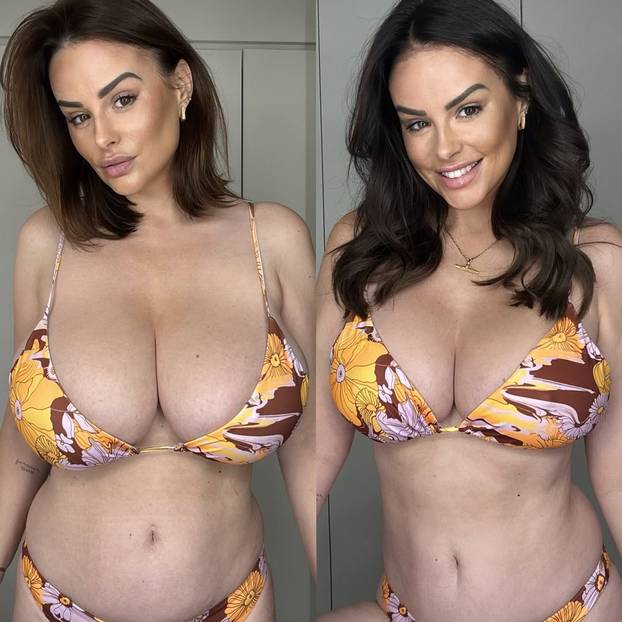 FOTO Poznata manekenka otišla na operaciju smanjenja grudi: 'Najbolja odluka u mom životu!'