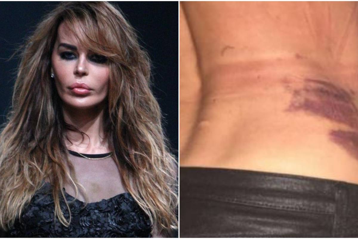 Nina Morić pokazala modrice i šokirala fanove: Tko te napao?