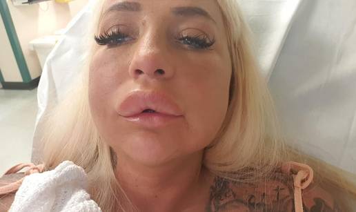 Htjela je ve&cacute;a usta, ali zbog stra&scaron;ne alergije je skoro umrla