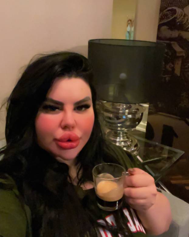 FOTO Stražnjica mi teži 45 kila, no već imam u planu sljedeću operaciju, želim imati najveću!