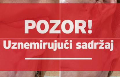 FOTO Potresne ispovijesti žrtava zagrebačkog estetskog kirurga: 'Osakaćene smo za cijeli život'
