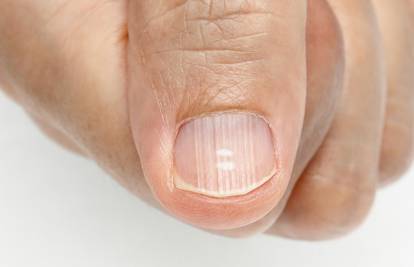 Kada doktoru: Imate vodoravne ili okomite nabore na noktima?
