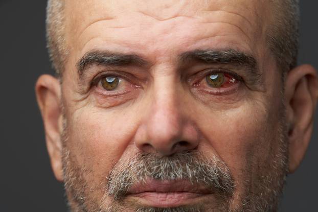 Close-up annoyed red blood eye of senior man