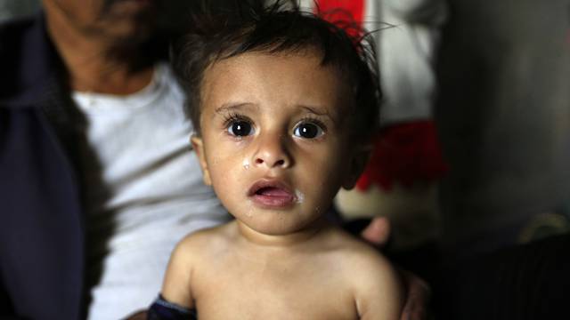 Najveća kriza: U Jemenu 360 tisuća životno ugrožene djece
