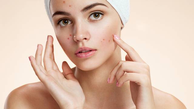 Mobiteli mogu prouzročiti akne i druge probleme s kožom lica