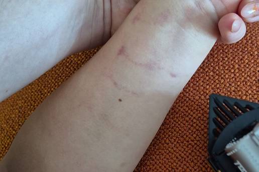 'Dijete je skrivalo ruku i žalilo se na bolove. Isprva nije htjelo reći da ga je ozlijedila teta...'